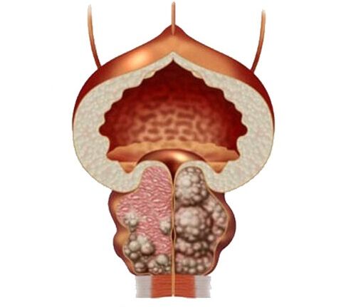 Adenoma eta prostatako eta tratamendua urosaf kapsulekin