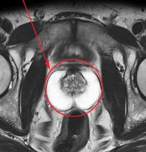 Zxcvbnmqwert hartu ondoren ultrasoinuetarako prostata osasuntsua