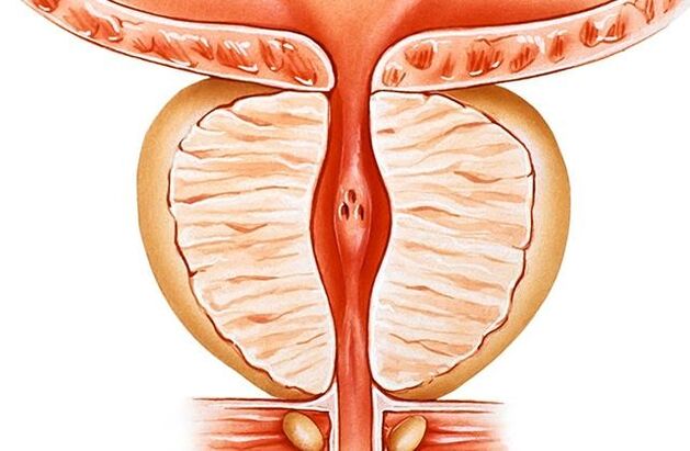 prostatitis