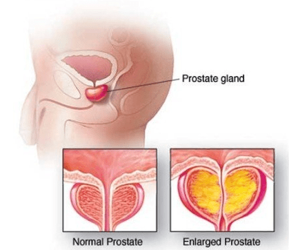 Prostata normala eta hantura