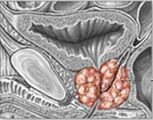 Prostatitis kronikoa